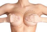 Гармоничная и привлекательная грудь: уменьшение бюста в «Первой многопрофильной клинике» Череповца